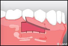 Chirurgie mucogingivale