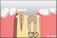 traitement radiculaire