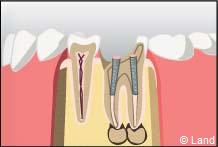 traitement radiculaire