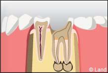 traitement radiculaire